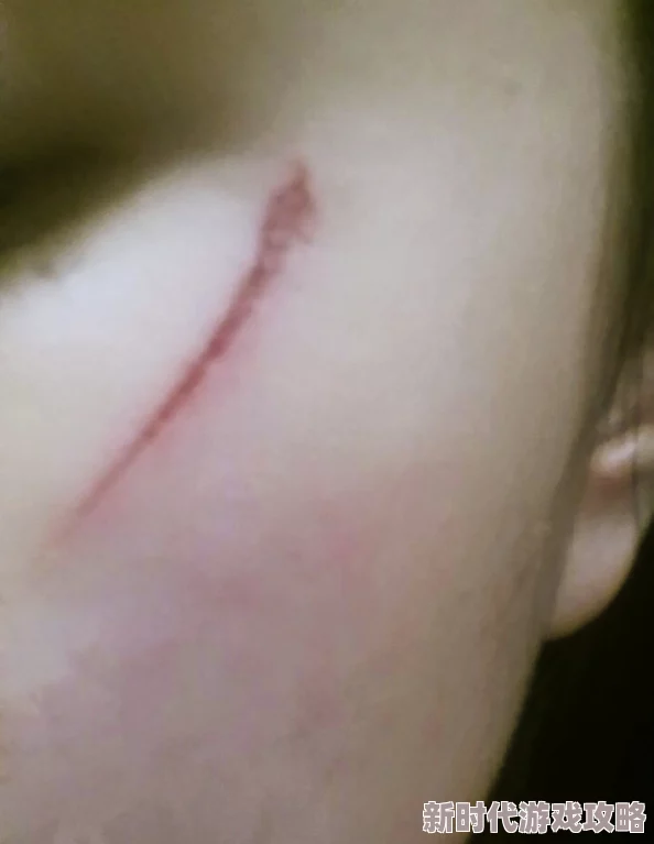 见缝插针如何防止留疤 | 有效预防疤痕的方法解析 见缝插针如何防止留疤 | 有效预防疤痕的方法解析
